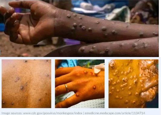 Expresses Concerns Over Surge of Mpox Cases in Neighboring Sierra Leone